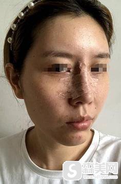 杜若溪整容了么？杜若溪整容揭秘,附真实隆鼻案例+隆鼻前后案例果图