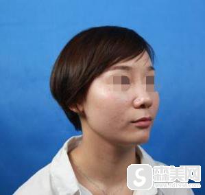 李心艾整容前后对比,附双眼皮案例+前后案例对比图