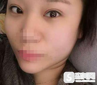 李心艾整容前后对比,附双眼皮案例+前后案例对比图
