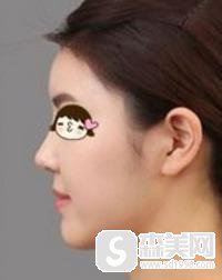 江门华美整容医院口碑怎么样？口碑好不好+专家介绍+隆鼻案例分享！