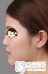 江门华美整容医院口碑怎么样？口碑好不好+专家介绍+隆鼻案例分享！