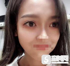 罗霈颖整容对比照,附双眼皮案例+双眼皮前后案例对比图