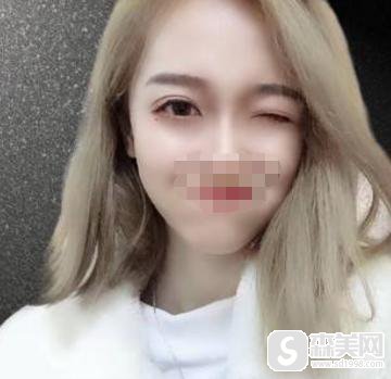 罗霈颖整容对比照,附双眼皮案例+双眼皮前后案例对比图