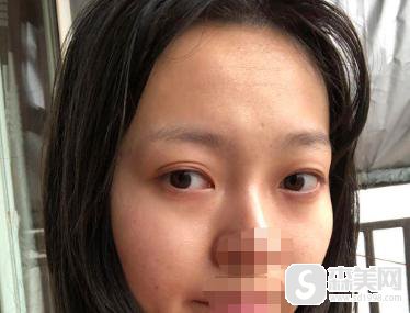 罗霈颖整容对比照,附双眼皮案例+双眼皮前后案例对比图