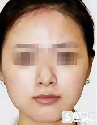 邓智仁医生怎么样?台州长青整形医院的口碑怎么样,面部提升案例分享