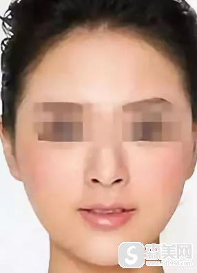 邓智仁医生怎么样?台州长青整形医院的口碑怎么样,面部提升案例分享