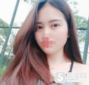 江门华美医疗美容院做的双眼皮怎么样？口碑情况+专家介绍+双眼皮案例！