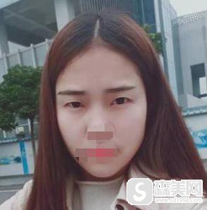 江门华美医疗美容院做的双眼皮怎么样？口碑情况+专家介绍+双眼皮案例！