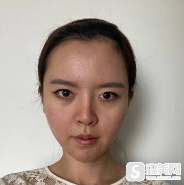 哈尔滨华美双眼皮埋线恢复时间,附案例详情+具体对比照