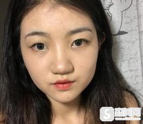 北京叶子整形医院双眼皮埋线价格,附80天恢复详情