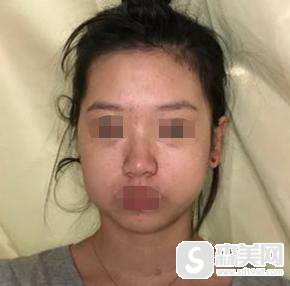 申世京整容前后对比,附下颌骨真实手术案例及果图对比分享!