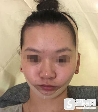 申世京整容前后对比,附下颌骨真实手术案例及果图对比分享!