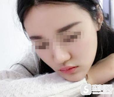 朴宝英整容前后对比，附磨骨手术真实案例分享＋磨骨前后果对比图