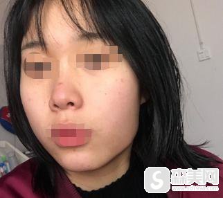 白小俺整容了吗？附白小俺整容解析及下颌角手术案例分享！