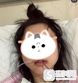 吴千语整容前后照片对比，附下颌角整形手术案例分享＋下颌角手术前后对比图