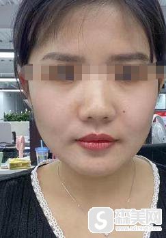 吴千语整容前后照片对比，附下颌角整形手术案例分享＋下颌角手术前后对比图