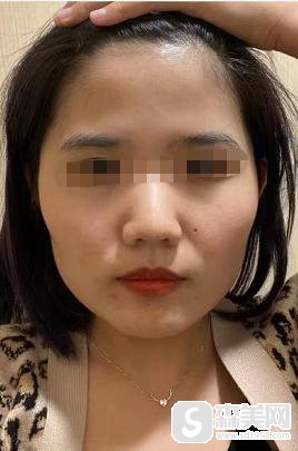 吴千语整容前后照片对比，附下颌角整形手术案例分享＋下颌角手术前后对比图