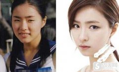 申世京整容前后对比照,附双眼皮案例分享+双眼皮前后果对比图