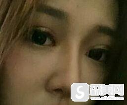 江映蓉整容前后对比照，附隆鼻案例分享＋隆鼻前后对比照
