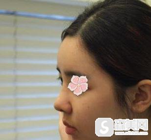 李钟硕整容前后对比,附隆鼻案例分享+隆鼻前后果对比图