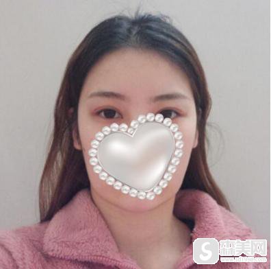 韩真真整容前后照片，附下颌角磨骨案例分享＋下颌角磨骨前后果对比图