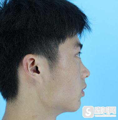 杭州新友好整形美容医院隆鼻做的好吗?附专业隆鼻案例分享