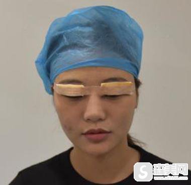 杭州艺星割双眼皮恢复过程图,附2021较新价格表