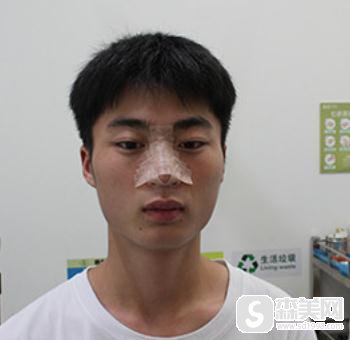 杭州新友好整形美容医院隆鼻做的好吗?附专业隆鼻案例分享
