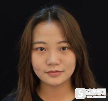 杭州艺星割双眼皮恢复过程图,附2021较新价格表