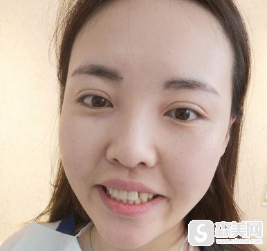 福州牙齿美白整形医院哪家好,福州协和具体案例展示