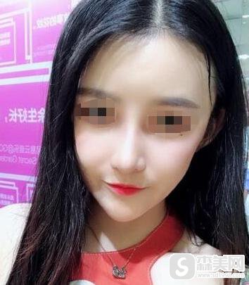 上海长征医院整形外科隆鼻好不好？口碑情况？内含相关案例分享！