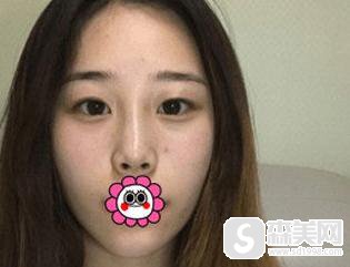 中日友好医院整形外科怎么样?口碑介绍+专家信息介绍+双眼皮案例分享!