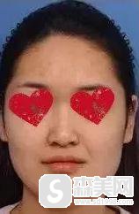 谢双灵隆鼻果怎么样？北京炫美医疗美容诊所怎么样,隆鼻案例分享