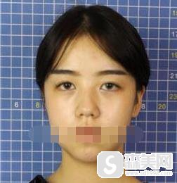 北京医院整形外科怎么样？口碑情况＋专家信息及隆鼻案例！