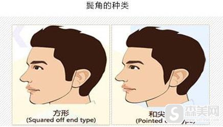 鬓角种植果怎么样？适应人群是哪些？附鬓角种植前后果图