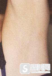 北京激光脱毛费用是多少附激光脱毛案例+脱毛前后果对比图