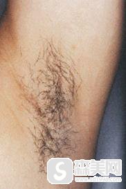 北京激光脱毛费用是多少附激光脱毛案例+脱毛前后果对比图