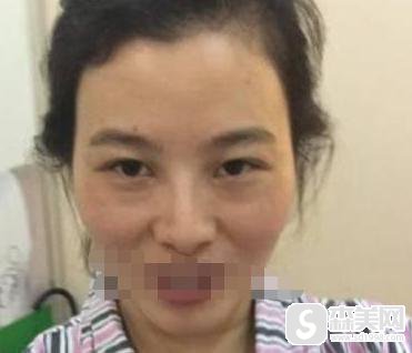 额头凹陷填充术多少钱?果怎么样?附额头凹陷填充手术案例分享