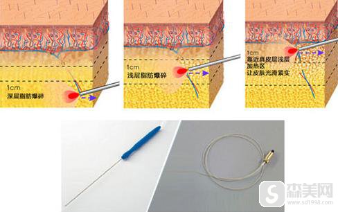 光纤溶脂原理是什么？价格是多少？附光纤溶脂案例前后果对比图