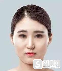 光纤溶脂原理是什么？价格是多少？附光纤溶脂案例前后果对比图