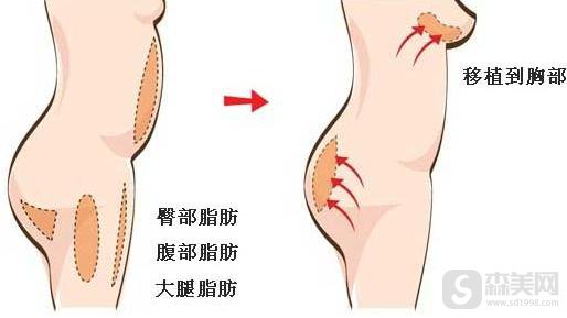 胸部整形的价格是多少以及方法有哪些？附隆胸案例前后果对比图