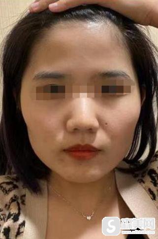 吴千语整容前后照片对比，附下颌角整形手术案例分享＋下颌角手术前后对比图