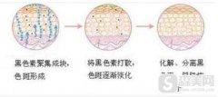 上海华美点阵激光恢复过程，附亲身案例分享＋照片对比