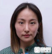 何萌萌的自体耳软骨隆鼻，北京美莱亲身案例介绍