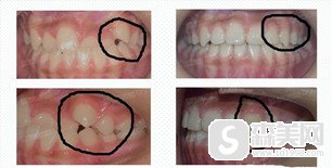 同济大学附属口腔医院好不好?医院的实力配备怎么样?隐形牙齿矫正的果怎么样?
