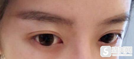 陈逸华医生坐诊于哪家医院?医院的口碑好不好?割双眼皮手术前后果对比图