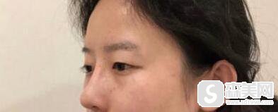 陈逸华医生坐诊于哪家医院?医院的口碑好不好?割双眼皮手术前后果对比图