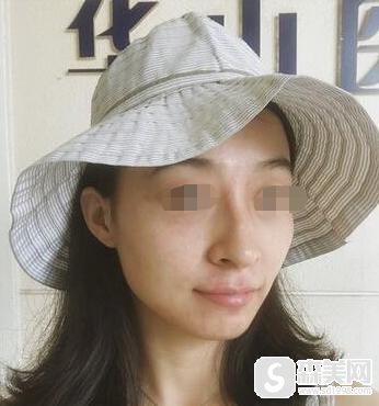 点阵激光后恢复过程图。附点阵激光案例