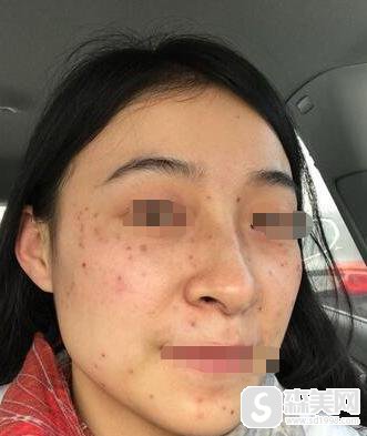 点阵激光后恢复过程图。附点阵激光案例
