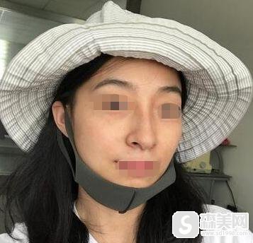 点阵激光后恢复过程图。附点阵激光案例